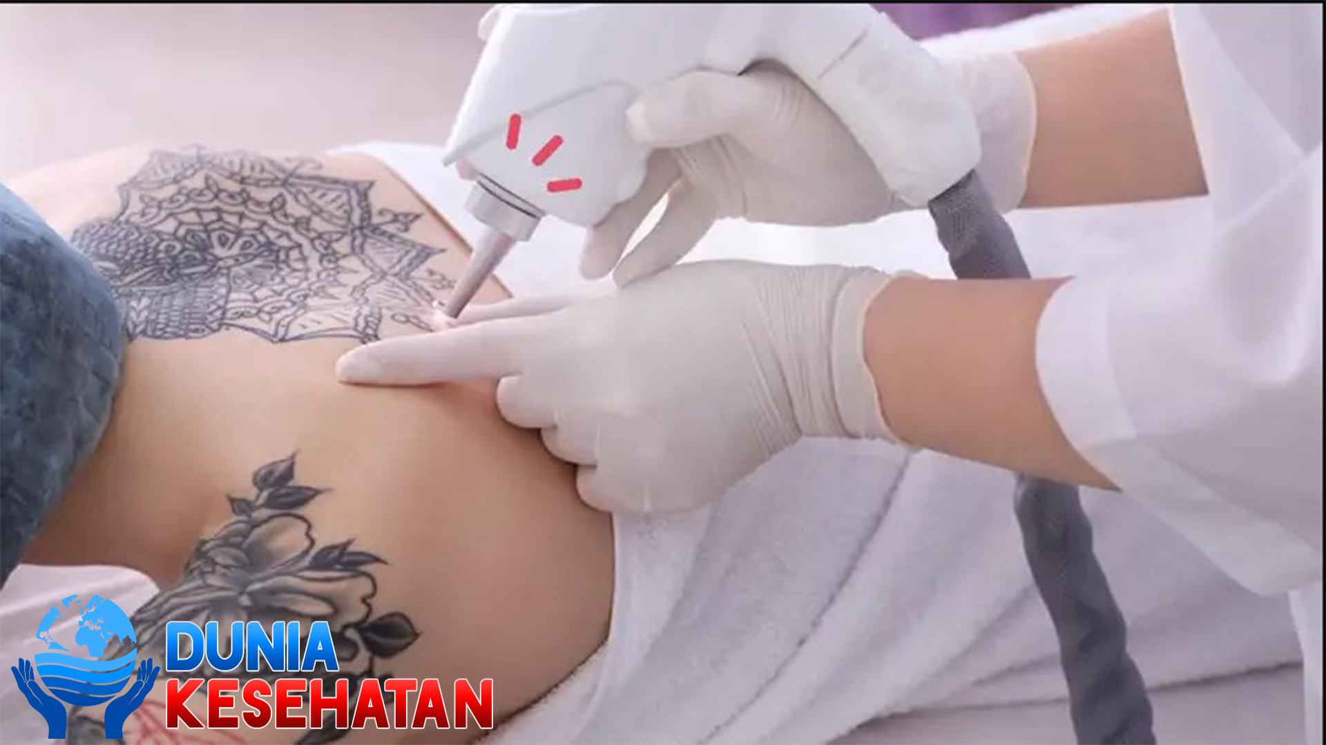 Cara Menghilangkan Tato Permanen secara Medis