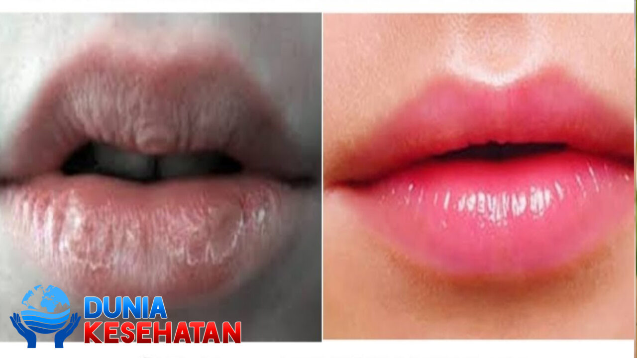 Cara Untuk Menghilangkan Bibir Hitam agar Makin Percaya Diri